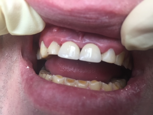 Central Incisor Crowns