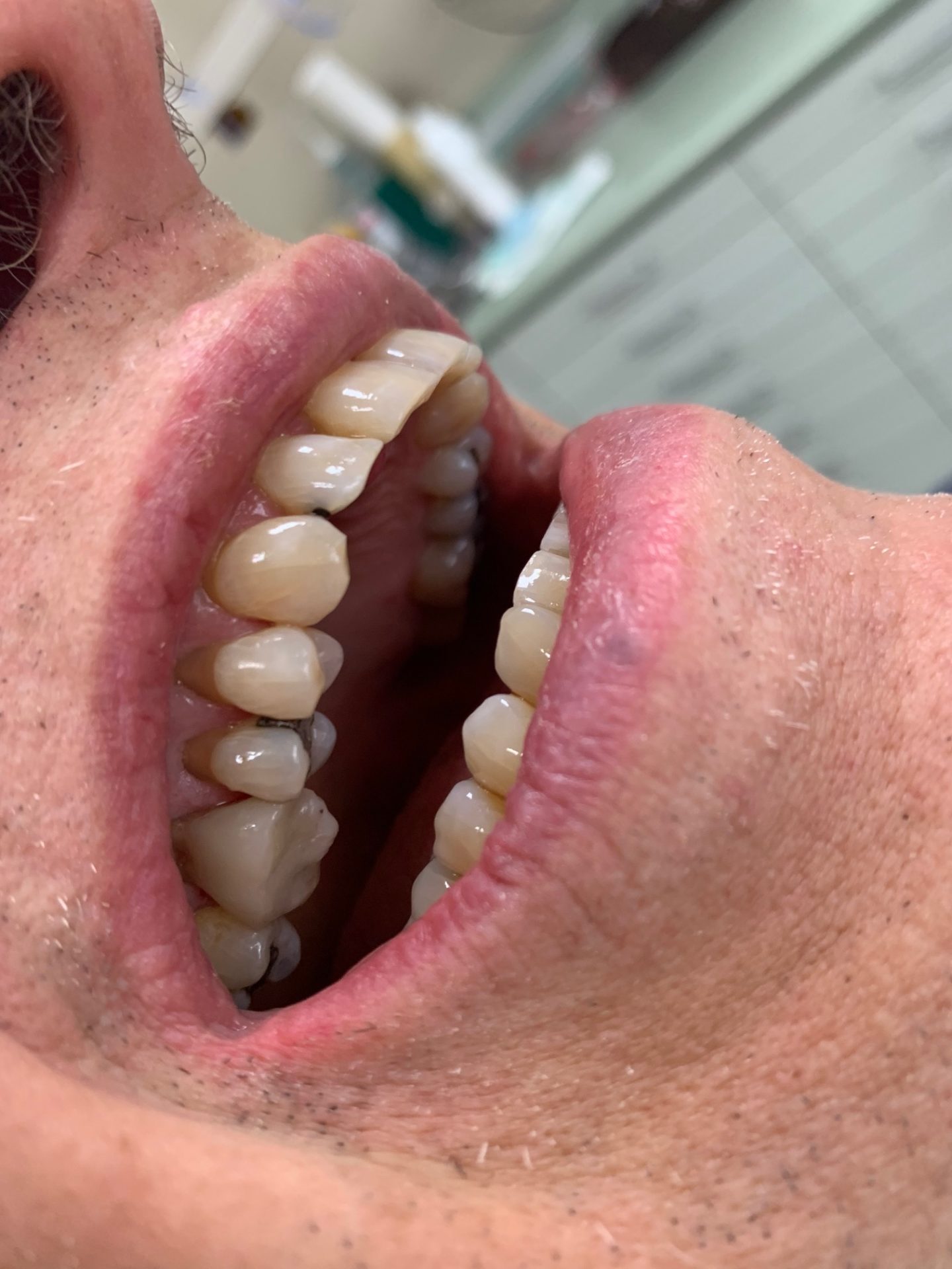 Molar Tooth Composite Resin Restoration