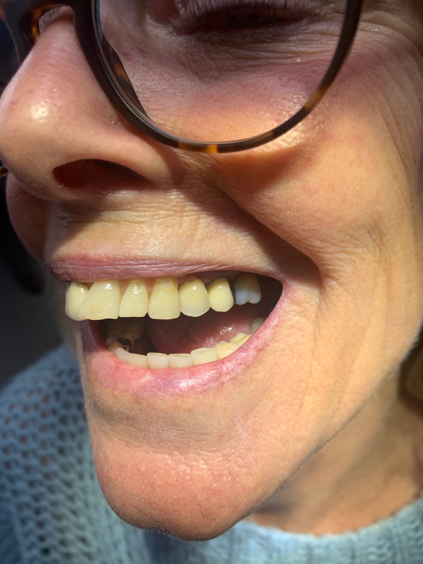 Premolar Implant
