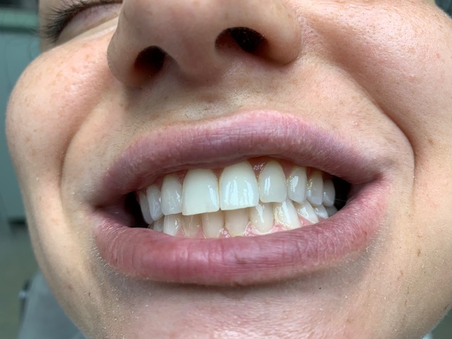 Upper Central Incisor Crown